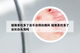 褪黑素吃多了會(huì)不會(huì)得白癜風(fēng) 褪黑素吃多了會(huì)長(zhǎng)白頭發(fā)嗎