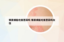 銀屑病能吃姜蔥蒜嗎 銀屑病能吃姜蔥蒜嗎女性