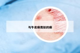 與牛皮癬類似的癬