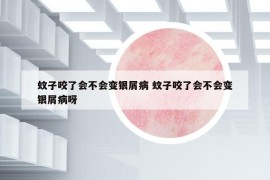 蚊子咬了會(huì)不會(huì)變銀屑病 蚊子咬了會(huì)不會(huì)變銀屑病呀