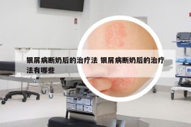 銀屑病斷奶后的治療法 銀屑病斷奶后的治療法有哪些