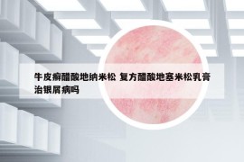 牛皮癬醋酸地納米松 復(fù)方醋酸地塞米松乳膏治銀屑病嗎