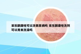 采樂酮康唑可以洗銀屑病嗎 采樂酮康唑洗劑可以用來洗澡嗎