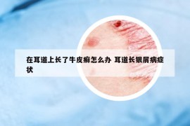 在耳道上長(zhǎng)了牛皮癬怎么辦 耳道長(zhǎng)銀屑病癥狀