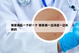 銀屑病起一個好一個 銀屑病一邊消退一邊長新的