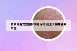 皮癬用曲安奈德封閉能治嗎 臉上長(zhǎng)癬用曲安奈德