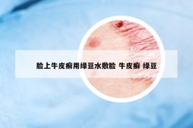 臉上牛皮癬用綠豆水敷臉 牛皮癬 綠豆