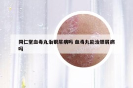 同仁堂血毒丸治銀屑病嗎 血毒丸能治銀屑病嗎