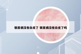 銀屑病沒有白皮了 銀屑病沒有白皮了嗎