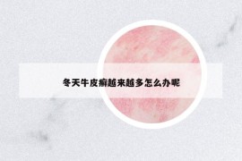 冬天牛皮癬越來越多怎么辦呢