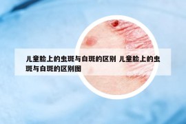 兒童臉上的蟲斑與白斑的區(qū)別 兒童臉上的蟲斑與白斑的區(qū)別圖