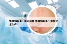 銀屑病如果不醫(yī)治后果 銀屑病如果不治療會(huì)怎么樣