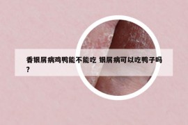 香銀屑病雞鴨能不能吃 銀屑病可以吃鴨子嗎?
