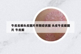 牛皮皮癬頭皮圖片早期癥狀圖 頭皮牛皮廨圖片 牛皮廨