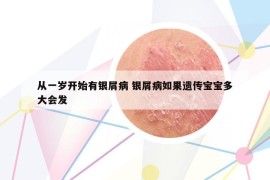從一歲開(kāi)始有銀屑病 銀屑病如果遺傳寶寶多大會(huì)發(fā)