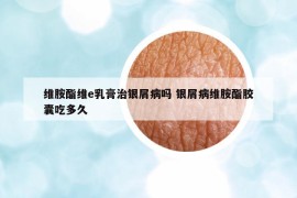 維胺酯維e乳膏治銀屑病嗎 銀屑病維胺酯膠囊吃多久