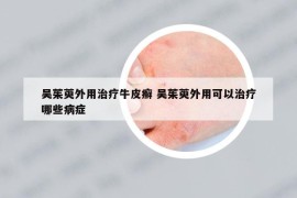 吳茱萸外用治療牛皮癬 吳茱萸外用可以治療哪些病癥