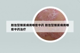 膿包型銀屑病用哪些中藥 膿包型銀屑病用哪些中藥治療