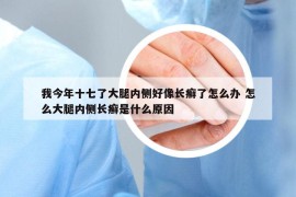 我今年十七了大腿內(nèi)側(cè)好像長(zhǎng)癬了怎么辦 怎么大腿內(nèi)側(cè)長(zhǎng)癬是什么原因