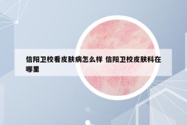 信陽(yáng)衛(wèi)?？雌つw病怎么樣 信陽(yáng)衛(wèi)校皮膚科在哪里