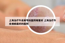 上海治療牛皮癬?？漆t(yī)院哪里好 上海治療牛皮病癬最好的醫(yī)院