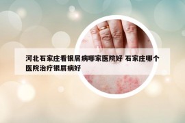 河北石家莊看銀屑病哪家醫(yī)院好 石家莊哪個(gè)醫(yī)院治療銀屑病好