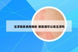 玉澤銀屑病用哪款 銀屑病可以用玉澤嗎