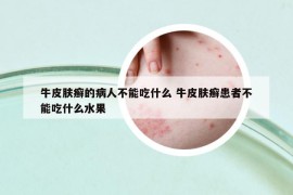 牛皮膚癬的病人不能吃什么 牛皮膚癬患者不能吃什么水果
