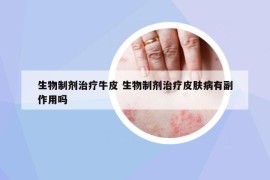 生物制劑治療牛皮 生物制劑治療皮膚病有副作用嗎