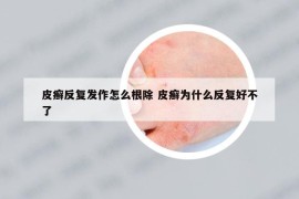 皮癬反復(fù)發(fā)作怎么根除 皮癬為什么反復(fù)好不了