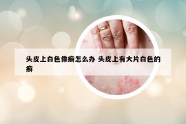 頭皮上白色像癬怎么辦 頭皮上有大片白色的癬