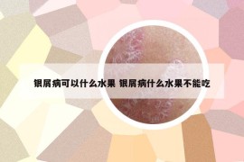 銀屑病可以什么水果 銀屑病什么水果不能吃
