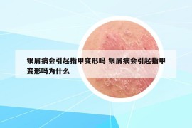 銀屑病會(huì)引起指甲變形嗎 銀屑病會(huì)引起指甲變形嗎為什么