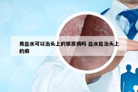 用鹽水可以治頭上的銀屑病嗎 鹽水能治頭上的癬