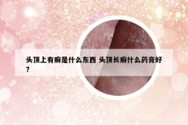 頭頂上有癬是什么東西 頭頂長癬什么藥膏好?