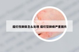 糜爛性腳蘚怎么處理 糜爛型腳癬嚴(yán)重圖片