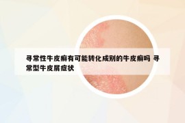 尋常性牛皮癬有可能轉(zhuǎn)化成別的牛皮癬嗎 尋常型牛皮屑癥狀