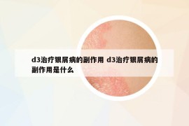 d3治療銀屑病的副作用 d3治療銀屑病的副作用是什么