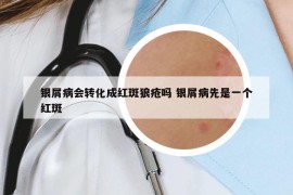 銀屑病會轉(zhuǎn)化成紅斑狼瘡嗎 銀屑病先是一個紅斑