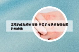 常見的皮膚癬有哪些 常見的皮膚癬有哪些圖片和癥狀