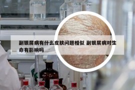 副銀屑病有什么皮膚問(wèn)題相似 副銀屑病對(duì)生命有影響嗎