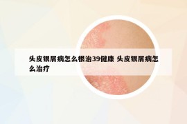 頭皮銀屑病怎么根治39健康 頭皮銀屑病怎么治療