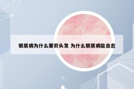 銀屑病為什么要剪頭發(fā) 為什么銀屑病能自愈