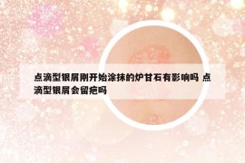 點(diǎn)滴型銀屑剛開始涂抹的爐甘石有影響嗎 點(diǎn)滴型銀屑會(huì)留疤嗎