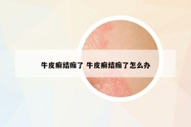 牛皮癬結(jié)痂了 牛皮癬結(jié)痂了怎么辦
