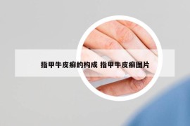 指甲牛皮癬的構(gòu)成 指甲牛皮癬圖片