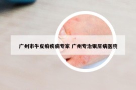 廣州市牛皮癬疾病專家 廣州專治銀屑病醫(yī)院