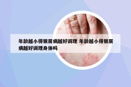 年齡越小得銀屑病越好調(diào)理 年齡越小得銀屑病越好調(diào)理身體嗎
