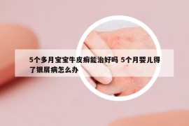 5個(gè)多月寶寶牛皮癬能治好嗎 5個(gè)月嬰兒得了銀屑病怎么辦