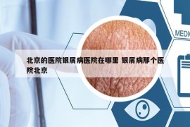 北京的醫(yī)院銀屑病醫(yī)院在哪里 銀屑病那個(gè)醫(yī)院北京